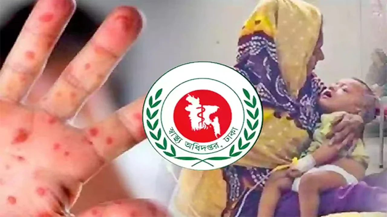 হাম ও হামের উপসর্গ নিয়ে আরো ৭ শিশুর মৃত্যু
