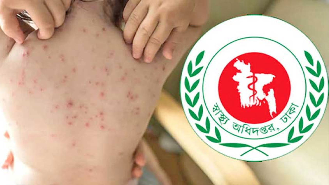হামের উপসর্গ নিয়ে আরো ৬ শিশুর মৃত্যু